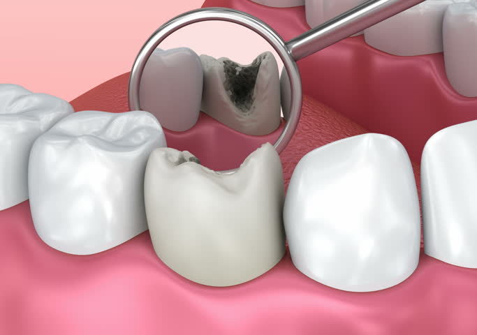 Causes of caries - sunny