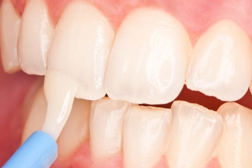 Tooth fluoridation