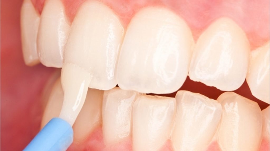 Tooth fluoridation