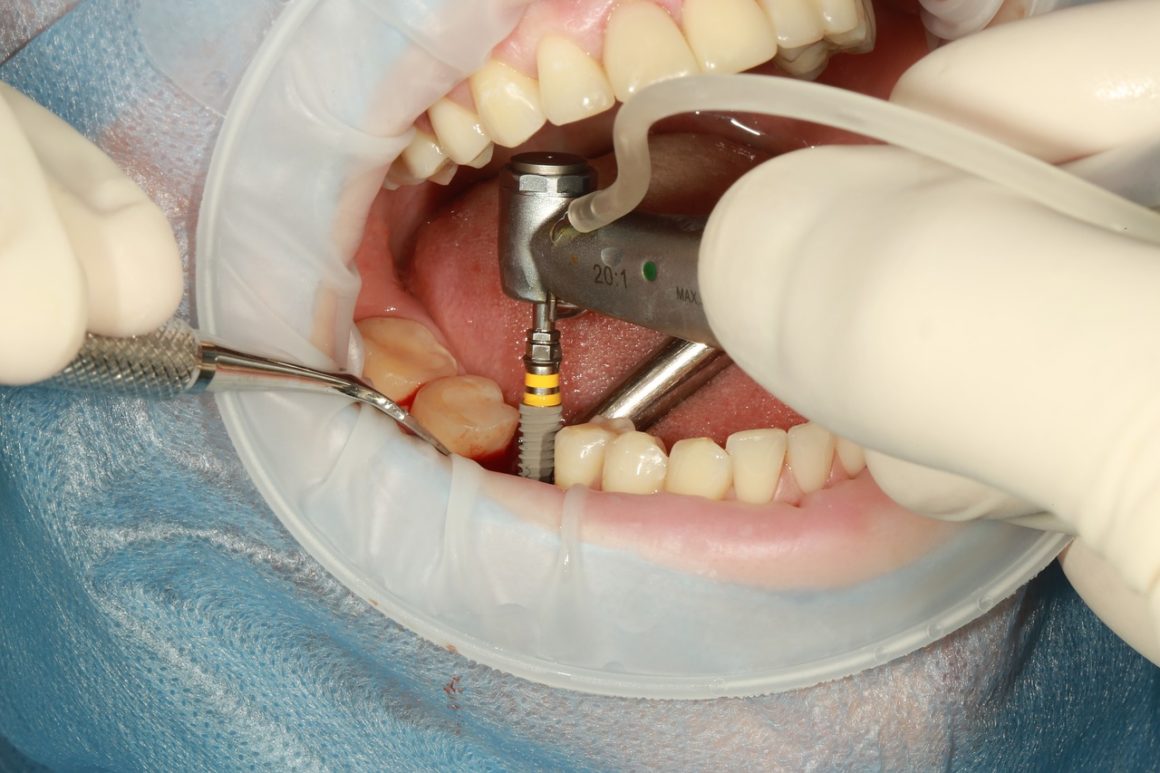 Types of dental implants: