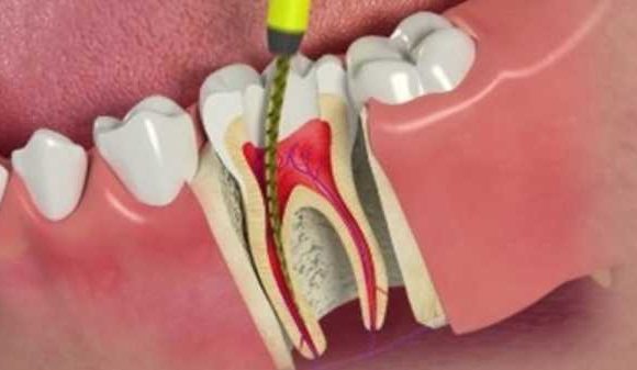 Лечение корней зубов