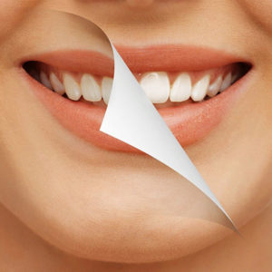 Противопоказания для отбеливания зубов